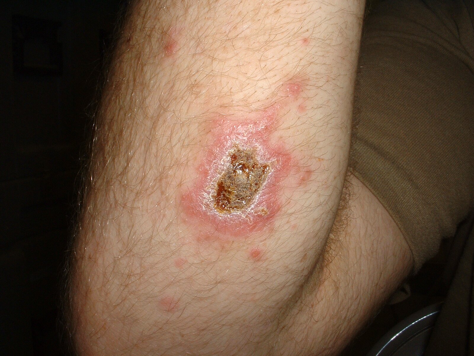 Leishmaniasis (leishmaniosis cutis) – CaliVita | Parasites Leishmaniasis (leishmaniosis cutis) – CaliVita | Parasites