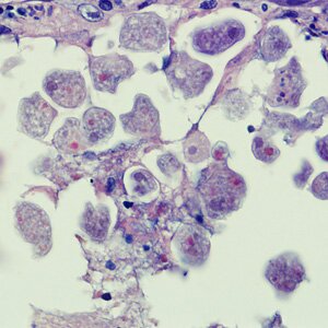 E_histolytica_perianal2