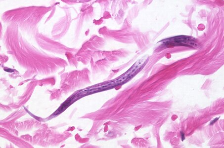 S_stercoralis_intbiopsy_400x_BAM1