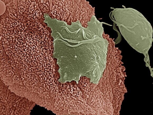 Trichomonas vaginalis